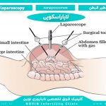 لاپاراسکوپی