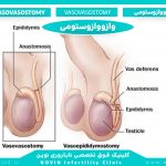 وازووازوستومی